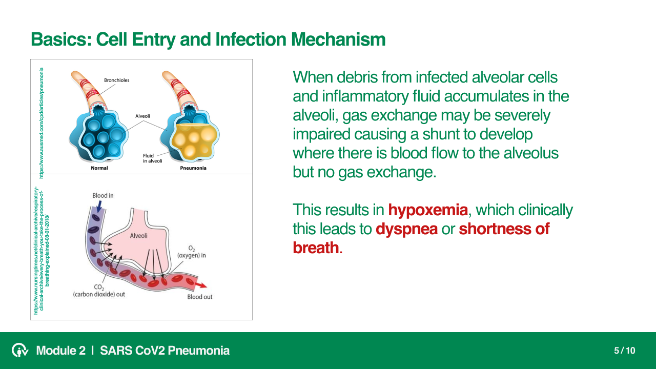 SARS CoV2 Physiology and Pneumonia slide 5